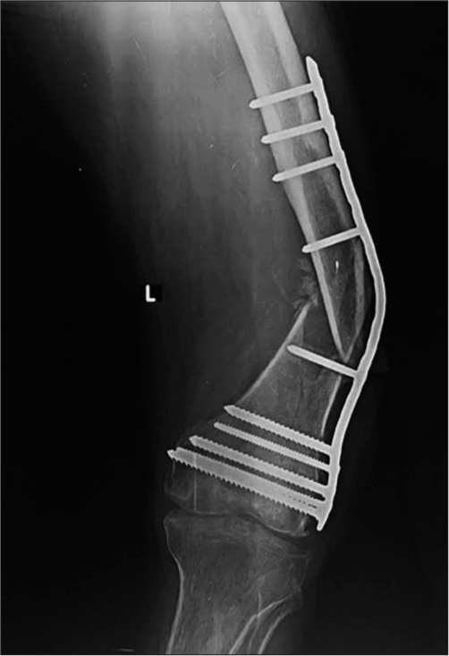 Anterior posterior radiograph of the femur showing a bent plate. During the initial phase of mobilization, the plates bear the load. Once the fracture gets “sticky” the bone starts to “share” the load. In the absence of a callus, the entire weight is taken by the plate, as seen in this case, leading to eventual failure.