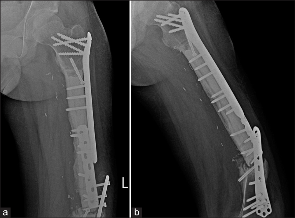 (a) Anterior posterior and (b) Lateral radiographs of the left thigh. Patient was a known case of Ewings sarcoma with surgical excision, cement placement. Buttressing and compression plates are seen in situ with loosening of the plates and screws on the background of a non-united fracture. Patient did not follow directions and mobilized early. The patient was operated upon again and was asymptomatic on follow up.