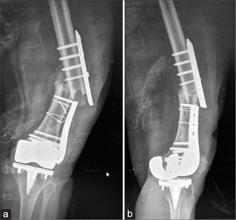 (a) Anterior posterior and (b) Lateral radiographs of the left thigh with knee. Morbidly obese patient, status post Total Knee Replacement (TKR) and diaphyseal fracture of the femur. Patient had a fall. Radiographs show intact knee prosthesis with a broken compression plate and refracture. See the beveled edges at the site of plate fracture, suggesting break at the screw hole.