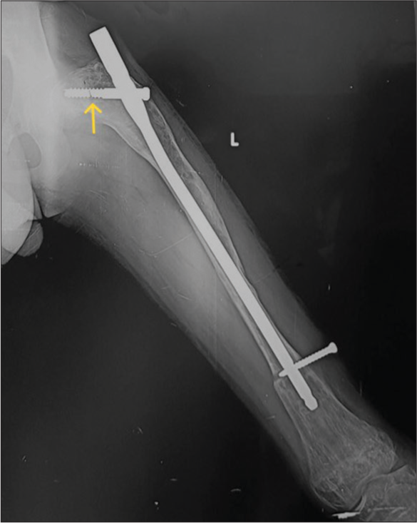 Anterior posterior radiograph of the left femur showing improper position of intramedullary nail-It is “proudly” (too proximal and outside the bone) placed with poor working length. Also, note the discontinuity in the proximal screw (yellow arrow) while the distal screw has backed out.