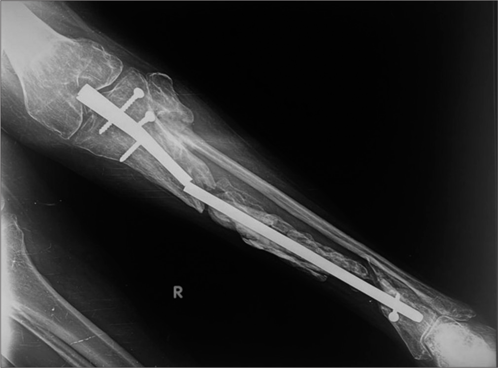 Anterior posterior radiograph of the leg with improperly positioned intramedullary (IM) nail with proximal end seen in the knee joint. There is non-union with sequestrum suggesting sequelae of infection. There is failure of the implant with fracture of the IM nail and proximal bolts.