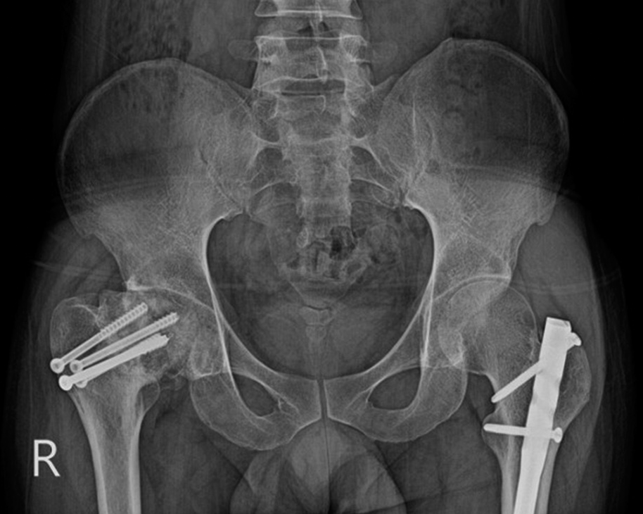 Anterior posterior radiograph of the pelvis. The patient was operated on for a fractured neck of the right femur with cannulated screws. The head is now collapsed with the loss of definition, consistent with avascular necrosis, which is a known complication. The radiologist needs to be aware of this complication and should look for it. Note is made of an intramedullary nail in the left femur, placed for femoral shaft fracture.
