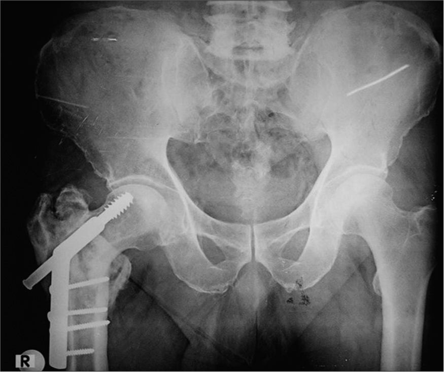 AP Radiograph of the pelvis with backed out dynamic hip screw. Note how the screw is displaced superiorly in the head of the femur.