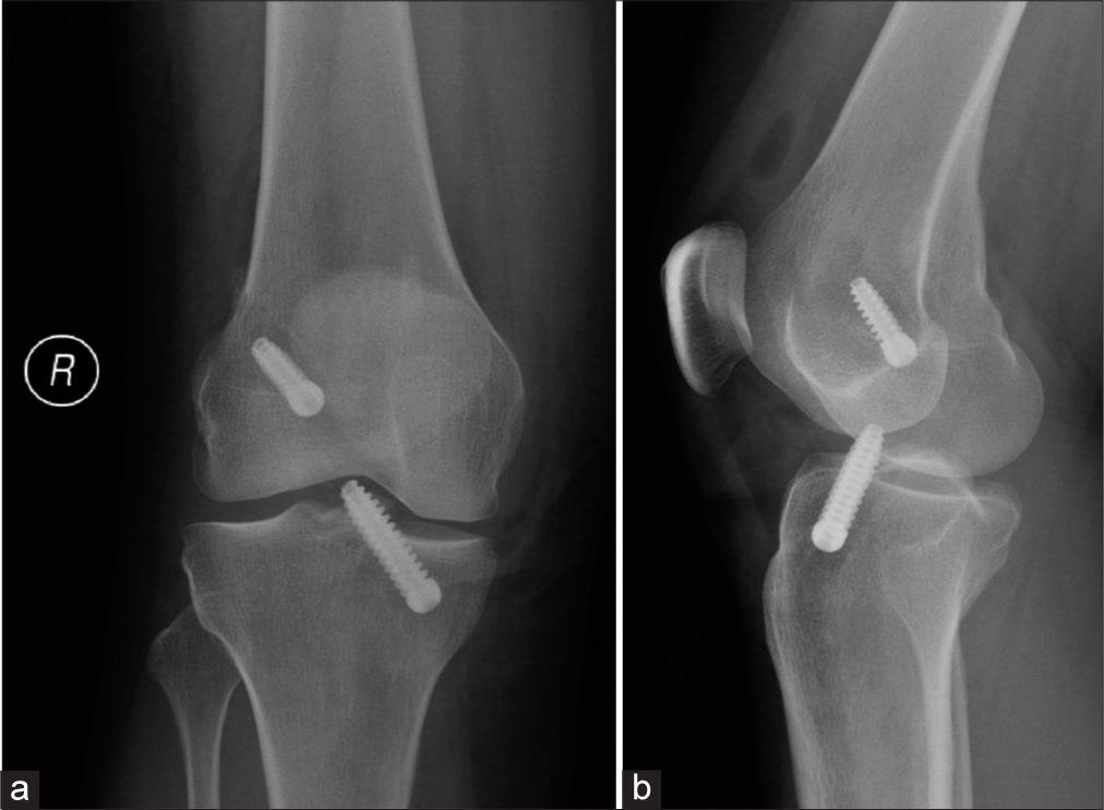 (a) Anterior posterior and (b) lateral knee radiographs taken immediately post-op (note the intra articular air) after anterior cruciate ligament reconstruction show unusually prominent tibial screw abutting the trochlear groove of the femur. (Image Courtesy Dr Raj Chari, Consultant Musculoskeletal Radiologist, Oxford University Hospitals NHS Trust).