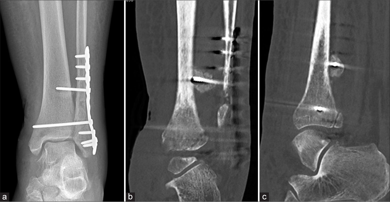 A 25-year-old man with increasing ankle pain following open reduction and internal fixation. (a) Anterior posterior radiograph of the ankle showing subtle lucency at the tip of the proximal tibia-fibula screw. It is unlikely to represent prosthetic loosening as the syndesmotic screw does not show other signs of loosening. (b) Coronal and (c) sagittal CT reformatted images show that the screw tip is situated posterior to tibia instead of within the tibia. Note significant callus formation around the screw tip. (Image Courtesy Dr Raj Chari, Consultant Musculoskeletal Radiologist, Oxford University Hospitals NHS Trust).