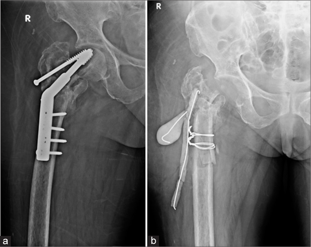 (a) Anterior posterior (AP) radiograph of the right hip show displaced dynamic hip screw with irregular lytic areas in the greater trochanter suspicious for infection. (b) AP view of the right hip, status post-surgical removal of the femoral head with placement of antibiotic laden K wires and cement. Cerclage wires were also placed for intra operative fracture of the shaft.