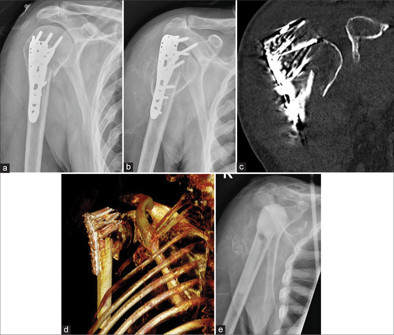 Anterior posterior radiographs of right shoulder taken 3 weeks apart (a) initial radiograph, (b) taken 3 weeks later, showing rapid destruction of the humeral head with exposed screws of the humeral internal fixation. Also note the multiple, old, rib fractures. (c and d), coronal and volume rendered CT images show exposed metal work and attenuation of the humeral head. (e) Post-operative Y view showing removal of metalwork and cement placement as a part of two stage replacement. (Image Courtesy Dr Raj Chari, Consultant Musculoskeletal Radiologist, Oxford University Hospitals NHS Trust).