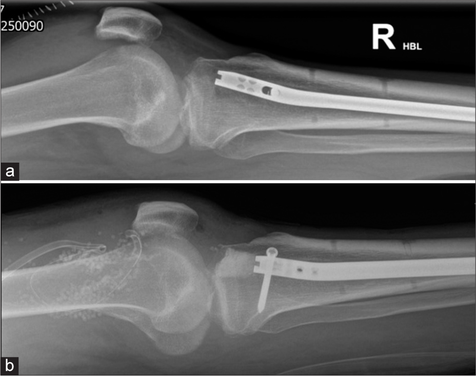 A 34-year-old man with a recent intramedullary nail fixation for a tibial fracture became acutely unwell within a week of his Surgery. (a) lateral knee radiograph on the 7th day shows large knee joint effusion which on aspiration grew Gram +ve cocci. (b) Lateral knee radiograph showing exchange of intramedullary nail, bone cement, intra articular antibiotic beads and surgical drain. (Image Courtesy Dr Raj Chari, Consultant Musculoskeletal Radiologist, Oxford University Hospitals NHS Trust).