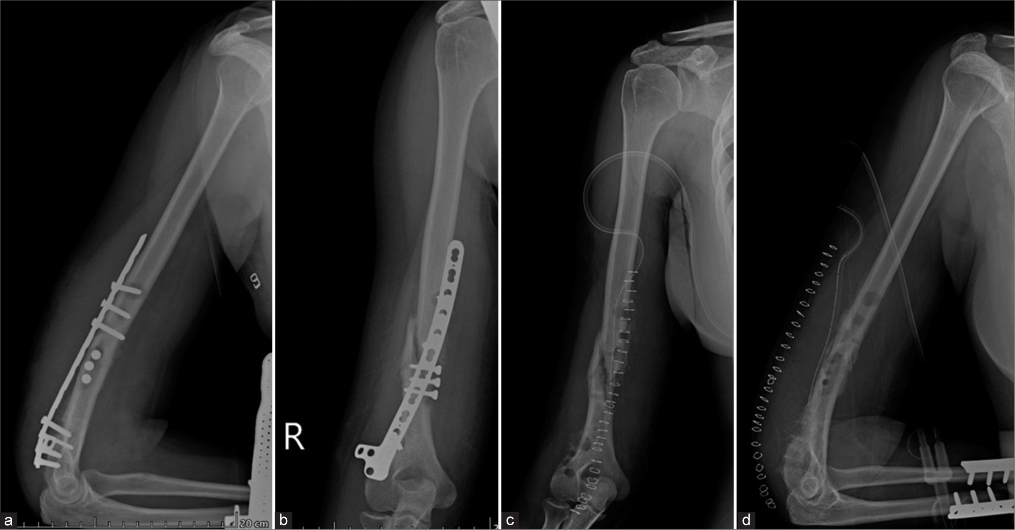 (a) Anterior posterior (AP) and (b) lateral views of the humerus. On the AP view, sclerotic fracture margins are seen suggesting oligotrophic nonunion, which is not identified on the lateral view. Alignment of bone is maintained. There is a loss of alignment of the compression plate on the AP view with a loss of contact distally, as seen on the lateral view. Well-defined lucencies are also seen around the proximal screws, indicating mechanical loosening. (c) AP and (d) lateral views of the humerus show surgical removal of the implant with the drain in situ. Also, note the compression plates for radial and fibular fractures on the lateral view.