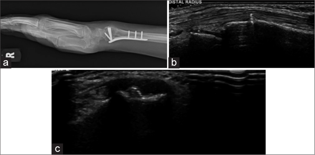 (a) Lateral radiograph of wrist showing plate and screw fixation. The distal row of screws was not seen to breach the cortex in the radiograph. (b and c) Longitudinal and transverse ultrasound images show a prominent screw tip adjacent to the Lister tubercle causing second extensor compartment tendinosis. (Image Courtesy Dr Raj Chari, Consultant Musculoskeletal Radiologist, Oxford University Hospitals NHS Trust).
