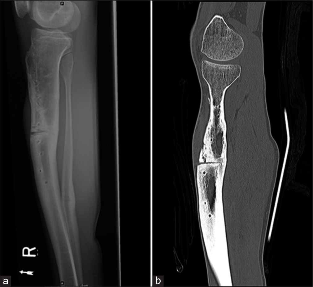 (a) Lateral radiograph of the leg shows non-union in the mid-shaft of the tibia with screw tracks from removed implants. An osteotomy was performed for the non-union. Also noted healed fracture of the distal shaft of the fibula. (b) Sagittal CT reformatted image shows a vertical fracture from the osteotomy which was not seen on the radiograph.