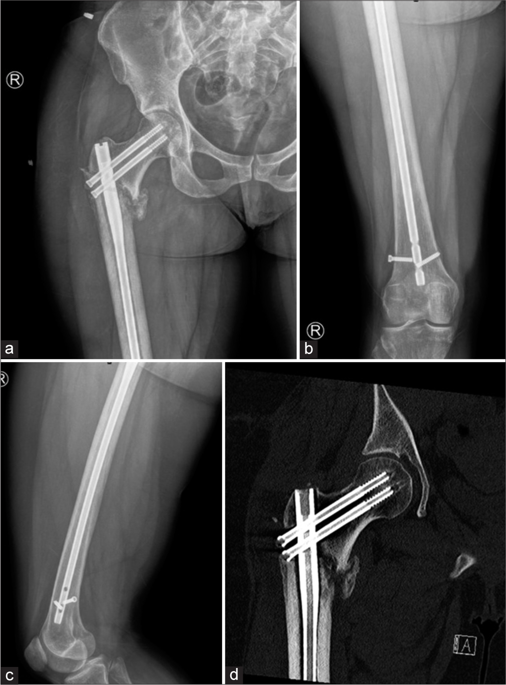 (a) Anterior posterior (AP) view of the right hip (b) AP view of the right thigh and (c) lateral view of the thigh shows lucency in the subtrochanteric region of the lateral femur from early loosening. Distal intramedullary rod- interlocking screw is broken with loosening. Also, the head of the distal of the two proximal screws is located within the fracture as shown in CT (d). Early loosening at the lateral subtrochanteric femur is confirmed on CT.