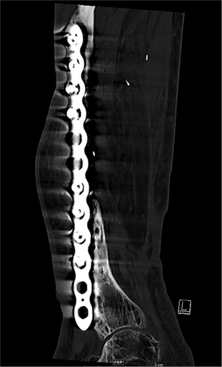 Sagittal CT reformatted radiographs of the tibia show a dynamic compression plate with backed out 3rd and 4th (counting from proximal) screws.