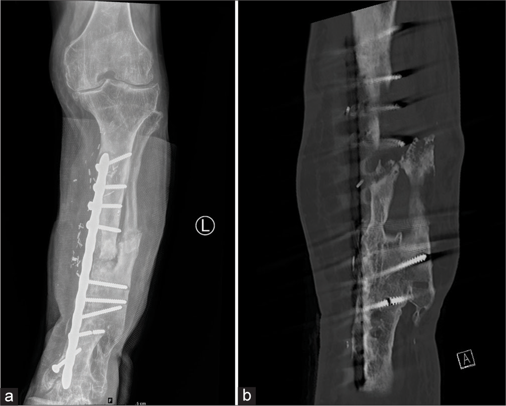 (a) Anterior posterior (AP) radiograph of the leg showing tibial and fibular fractures dynamic compression plate and vascularized graft. Note that screw fracture was identified on both the radiograph and CT (b). The position of the screws is better seen within the new bone on CT due to reformats.