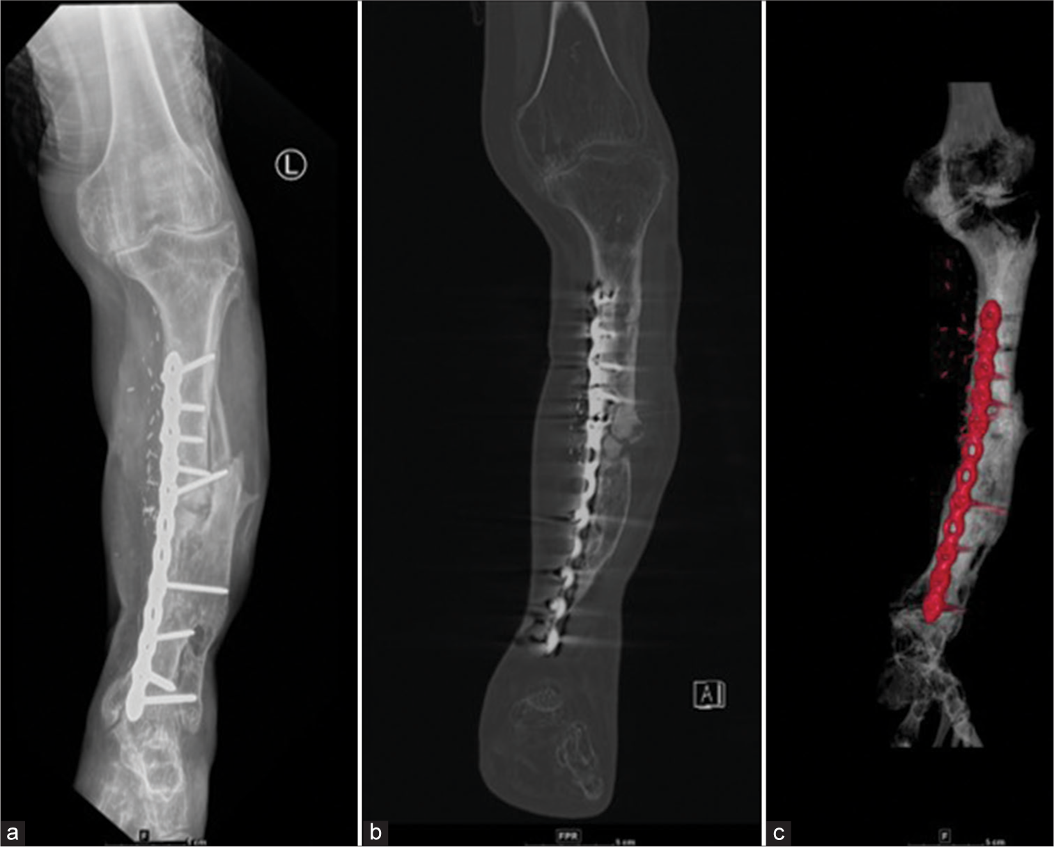 (a) Anterior posterior (AP) radiograph of the leg with (b) CT coronal and (c) 3D reformations with vascularized graft show break in the dynamic compression plate, proximal to the 5th screw (counted cephalic to caudal); Confirmed on CT reformats but sometimes as in this case, plain radiographs demonstrate hardware failure better. So always compare with plain radiographs.