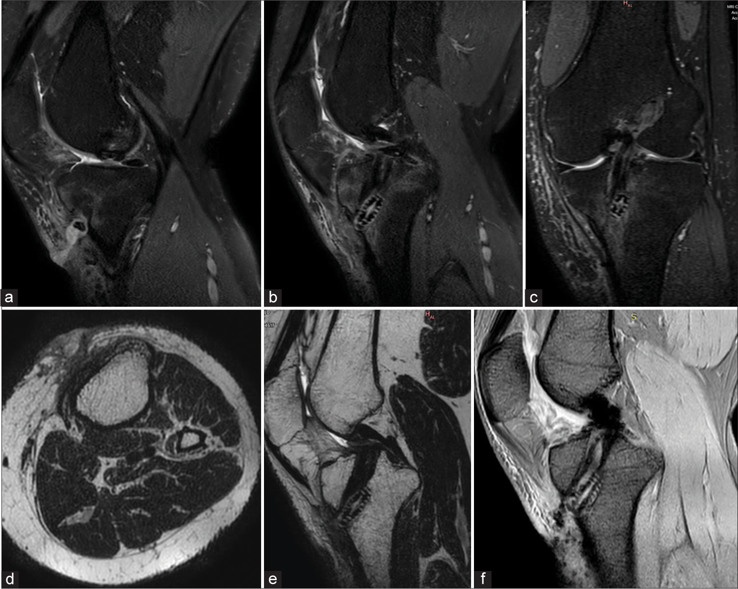Same Patient as Image 8. Status post-double bundle anterior cruciate ligament repair. The patient presented with discharging sinus in the proximal leg. (a) Proton density fat-saturated sequence extreme sagittal and (b) midsagittal images show a hyperintense track in the soft tissues anterior to the tibia extending up to the dermis with marrow edema in the tibia. Soft-tissue edema is also seen in the soft tissues anteriorly and medially (c) on the coronal images. (d) Axial T2W image at the level of the tibia showing the track in the subcutaneous planes breaches the skin. (e) Corresponding Midsagittal T2W image. (f) Gradient echo sequences mid sagittal image showing foci of blooming in the intercondylar region and pretibial soft tissues.