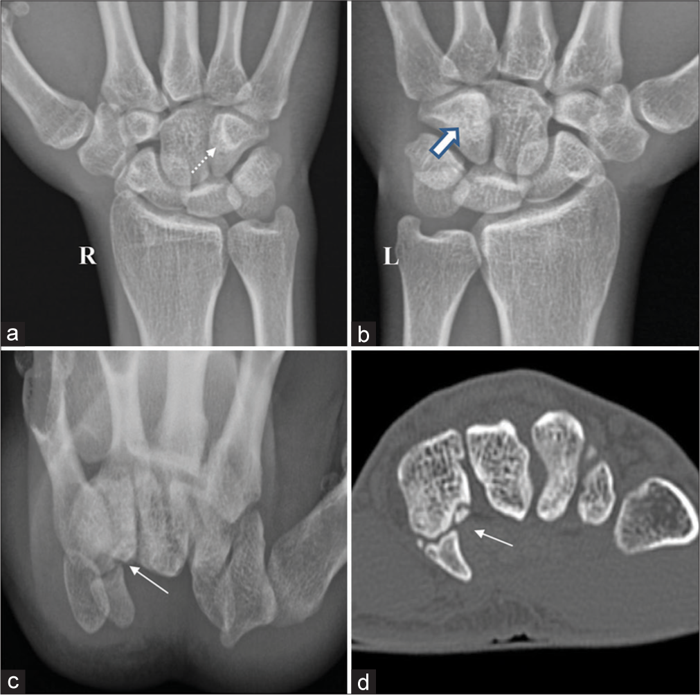 Hamate fracture in the non-dominant left wrist of a 23-year-old cricketer. (a) AP radiograph of the right wrist reveals the normal triangular appearance of the hook of hamate (dotted arrow). (b) The AP radiograph of the left wrist shows mild sclerosis in the left hamate bone with non-visualization of the triangular hook of the hamate (white arrow). (c and d) Carpal tunnel view radiograph and axial computed tomography of the left wrist reveal an old fracture of the hook of the hamate with sclerotic margins (thin white arrows).