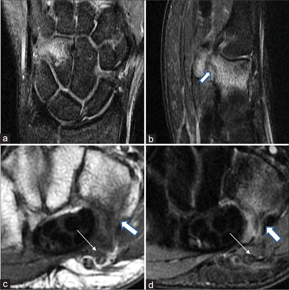 Hamate stress fracture in the non-dominant wrist of a 21-year-old batsman presenting with ulnar-sided wrist pain. (a) Coronal proton density fat-suppressed (PDFS) images show ill-defined areas of marrow edema compatible with hamate bone contusion (*). (b-d) A well-defined hypointense dark linear signal (thick white arrow) is seen at the hook of hamate in sagittal PDFS (b), axial T1-weighted (c), and axial short-tau inversion recovery weighted (d) images. The thin white arrows mark blurring of the perineurial fat stripe along the ulnar nerve, which internally does not show any abnormal signal (c and d).