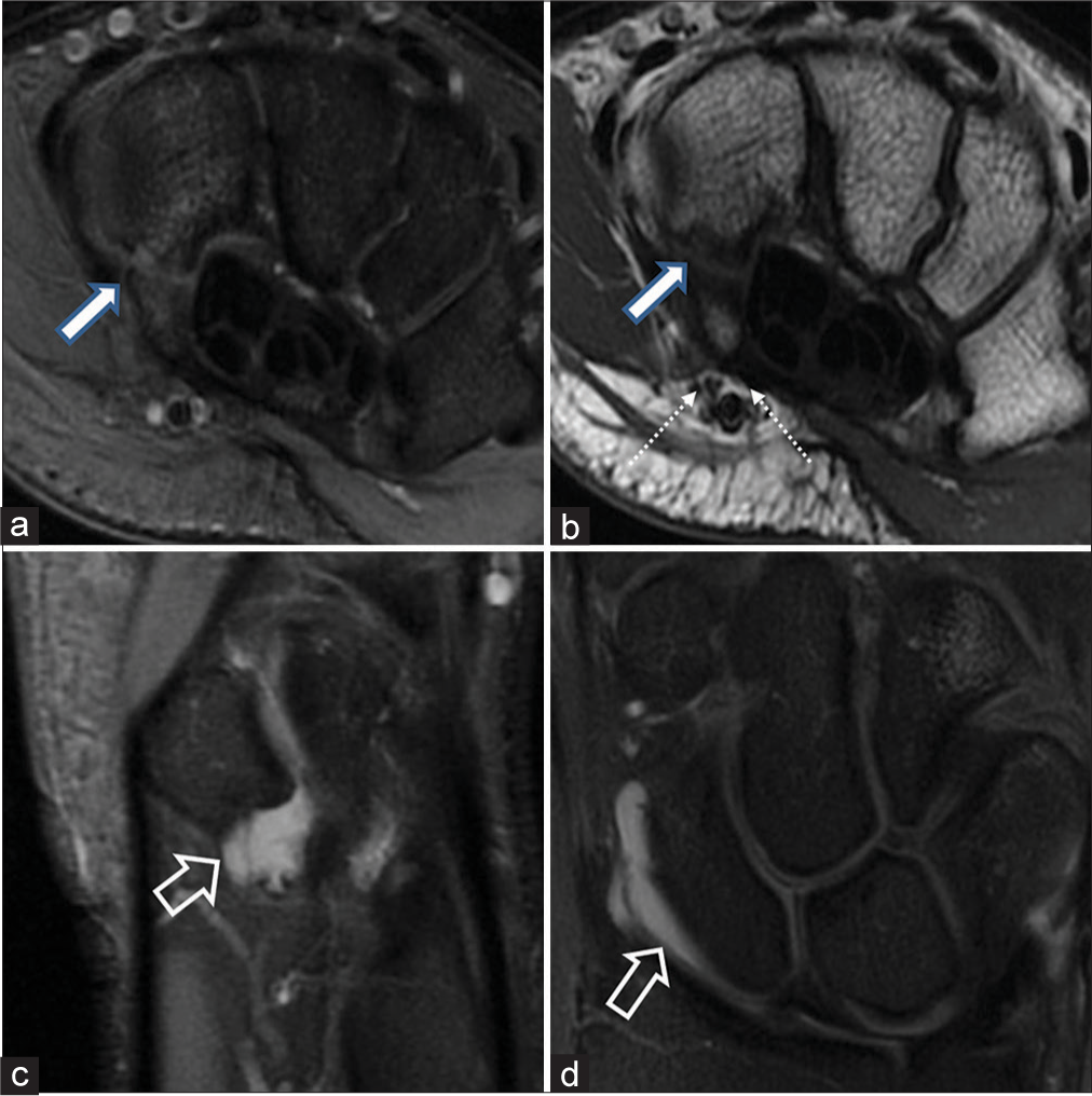 Volar-sided pain in the left wrist of a 22-year-old batsman. (a and b) Axial proton density fat-suppressed and T1W images delineate a mildly distracted hamate hook fracture (thick white arrows) with intervening intermediate bright signal at the fracture site. The two branches of the ulnar nerve (medial-motor and lateral-sensory) marked by dotted white arrows (b) are intimately associated with the tip of the hamulus and show preserved perineurial fat stripe, excluding traumatic neuritis. (c and d) Small multiloculated ganglion cyst is seen (open arrow) at the pisotriquetral articulation (c) and deep to the radioscaphocapitate volar extrinsic ligament (d).