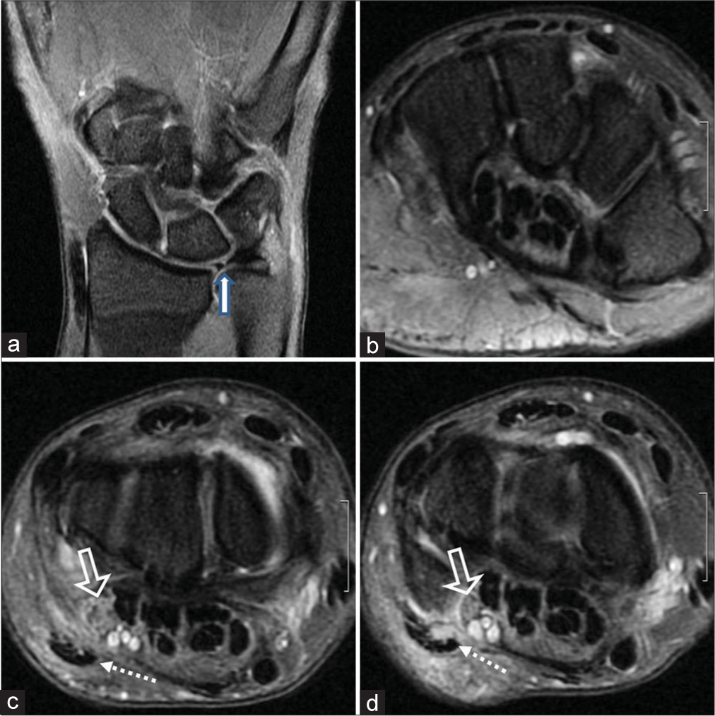 Elongated hamate hook with ulnar nerve neuritis and Palmer type IA triangular fibrocartilage complex injury in a 40-year-old cricketer presenting with paresthesia in the little and ring fingers. (a) Palmer type 1 central perforation is seen in the triangular fibrocartilage (thick white arrow). (b) Axial proton density fat-suppressed (PDFS) images reveal an elongated hook of hamate without any fracture or marrow edema in the hamate bone. (c and d) The ulnar nerve appears thickened and edematous with intrasubstance and perineural PDFS hyperintense signals consistent with ulnar neuritis (open arrows). The flexor carpi ulnaris tendon (dotted white arrows) also appears thickened and hyperintense on PDFS images with longitudinal interstitial tears and extensive soft-tissue inflammation in the hypothenar eminence.