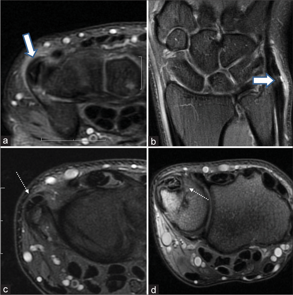 Extensor carpi ulnaris (ECU) tendinosis in a 32-year-old cricketer with ulnar-sided pain in the leading wrist. (a and b) Marked thickening with intrasubstance hyperintense signal is seen in the ECU tendon on axial and coronal proton density fat-suppressed (PDFS) images (thick white arrow) with peritendinous edema and subsheath edema suggesting ECU tendinosis with tenosynovitis. (c and d) Axial PDFS images reveal irregular longitudinal splitting of the ECU tendon (dotted white arrow).