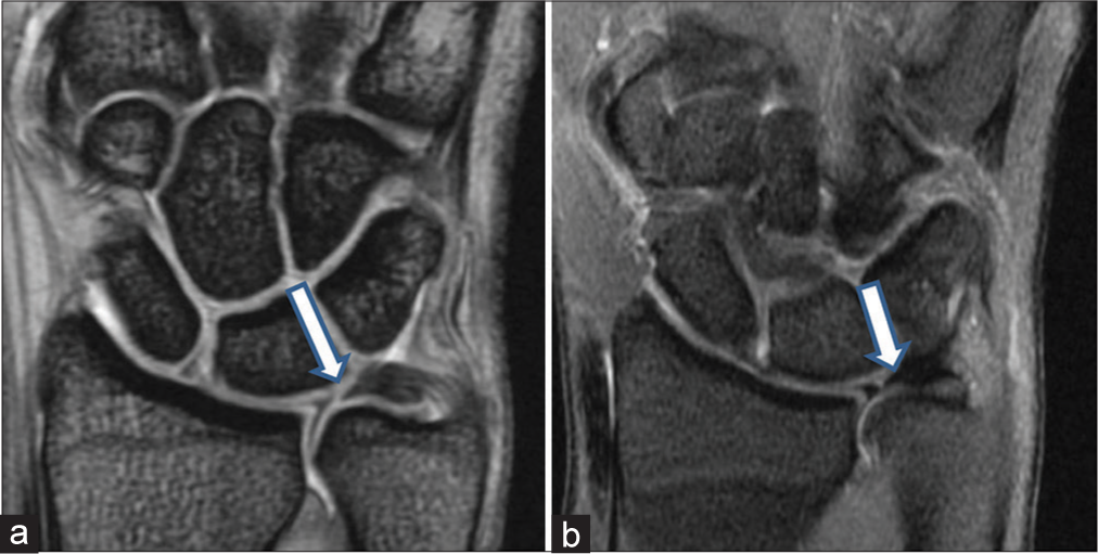 Triangular fibrocartilage complex (TFCC) injury in a 31-year-old bats men with ulnar-sided pain in the non-dominant wrist. (a and b) Coronal GRE and proton density fat-suppressed images depict a central perforation (white arrows) through the triangular fibrocartilage consistent with Palmer type 1A TFCC injury.