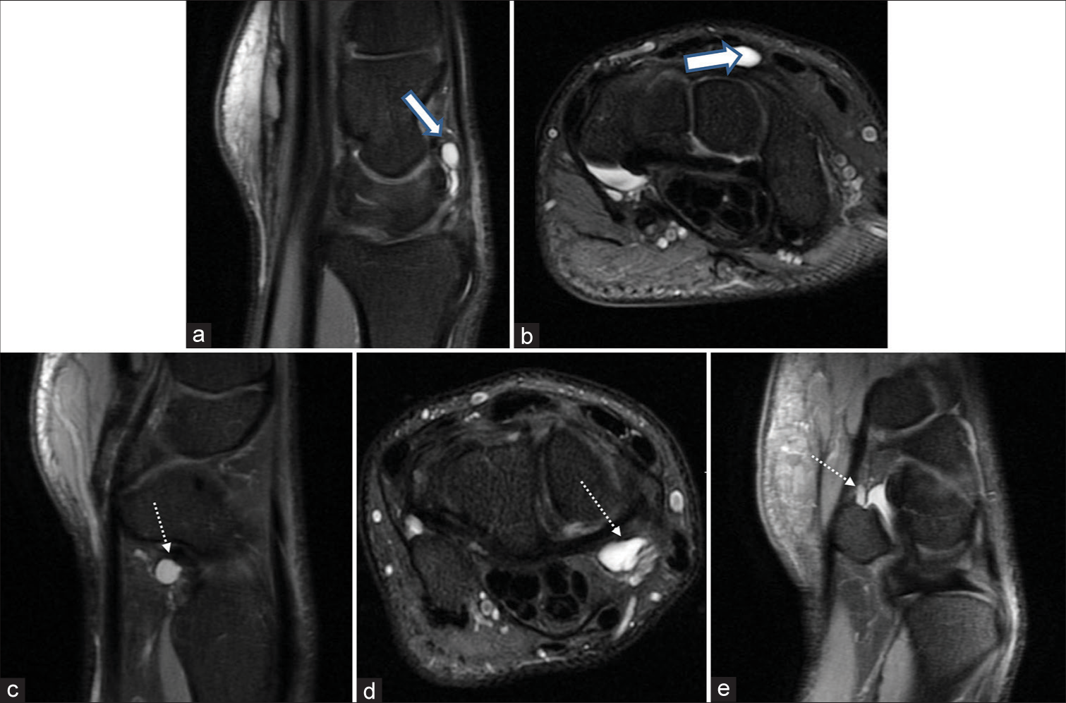 Ganglion cysts in the left wrist of a 31-year-old batsmen. (a and b) Sagittal and axial proton density fat-suppressed (PDFS) images reveal a multiloculated ganglion cyst on the dorsal aspect of the luno-capitate articulation along the dorsal scapholunate ligament (thick white arrow). (c and d) A ganglion cyst is seen along the volar radioscapholunate ligament (dotted white arrow). (e) Sagittal PDFS images reveal a ganglion cyst at the piso-triquetral articulation (dotted white arrow).