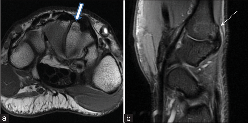 Carpal bossing in a 34-year-old male with pain on the dorsal aspect of the non-dominant wrist. A hypertrophied bony protuberance is seen on the dorsal (a) aspect of the trapezoid bone (thick white arrow) and the base (b) of the 2nd metacarpal (dotted white arrow) suggestive of bone bossing. Mild dorsal capsular hypertrophy is also noted. No extensor tendinitis seen.
