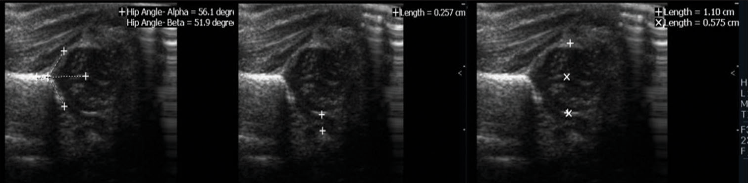 Graf classification IIa with normal bony rim percentage and pubofemoral distance (between cursors) in 5-day-old infant.