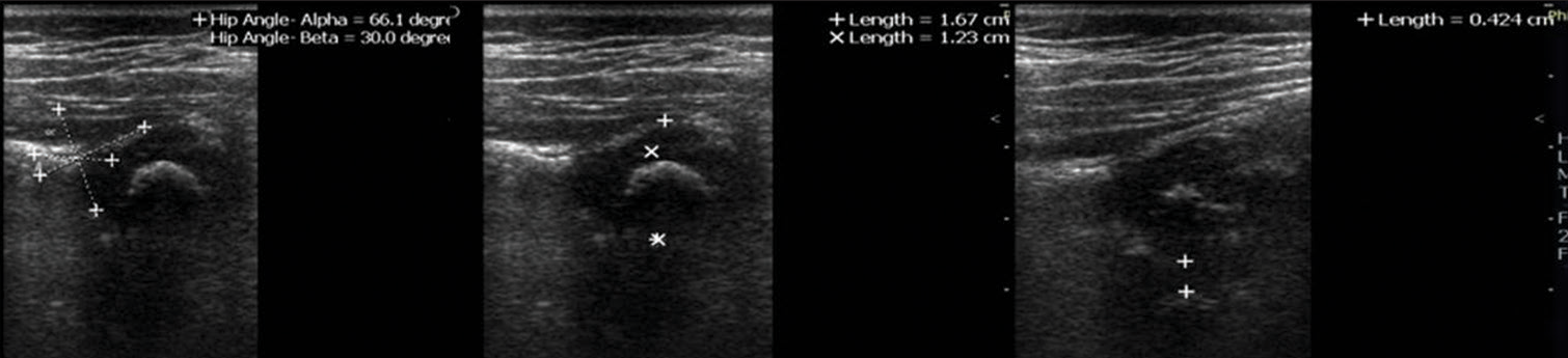 Graf classification I with normal bony rim percentage and pubofemoral distance (between cursors) in 8 m infant with hyperechoic femoral head epiphyseal center seen.