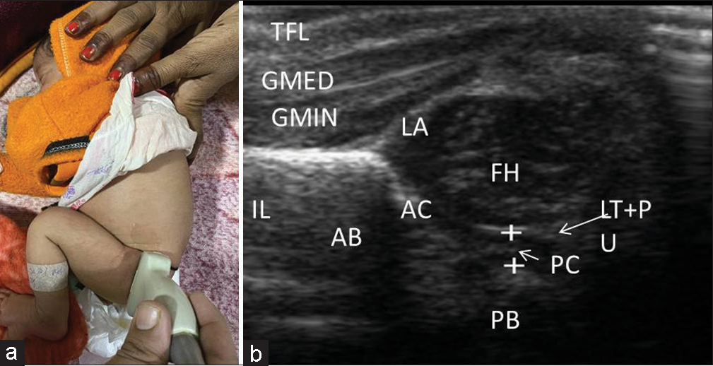 (a) Image demonstrating the positioning of the patient in lateral decubitus with the side to be examined upward, and the correct positioning of the transducer. The examined limb is in flexed and neutral position with a transducer perpendicular to the bed, to obtain an image of the hip in the coronal plane. (b) Anatomical landmarks in the normal hip: Muscular planes: Tensor fascia lata (TFL) muscle, gluteus medius (GMED) muscle, and gluteus minimus (GMIN) muscle. Bony landmarks: Acetabulum (AB) and pubic bone (PB). Cartilaginous structures: Femoral head (FH), acetabular cartilage (AC), and pubic cartilage (PC). Others: Labrum (LA) and ligamentum teres (LT) (indistinguishable from the fatty pulvinar (PU) and pubofemoral distance (between cursors).