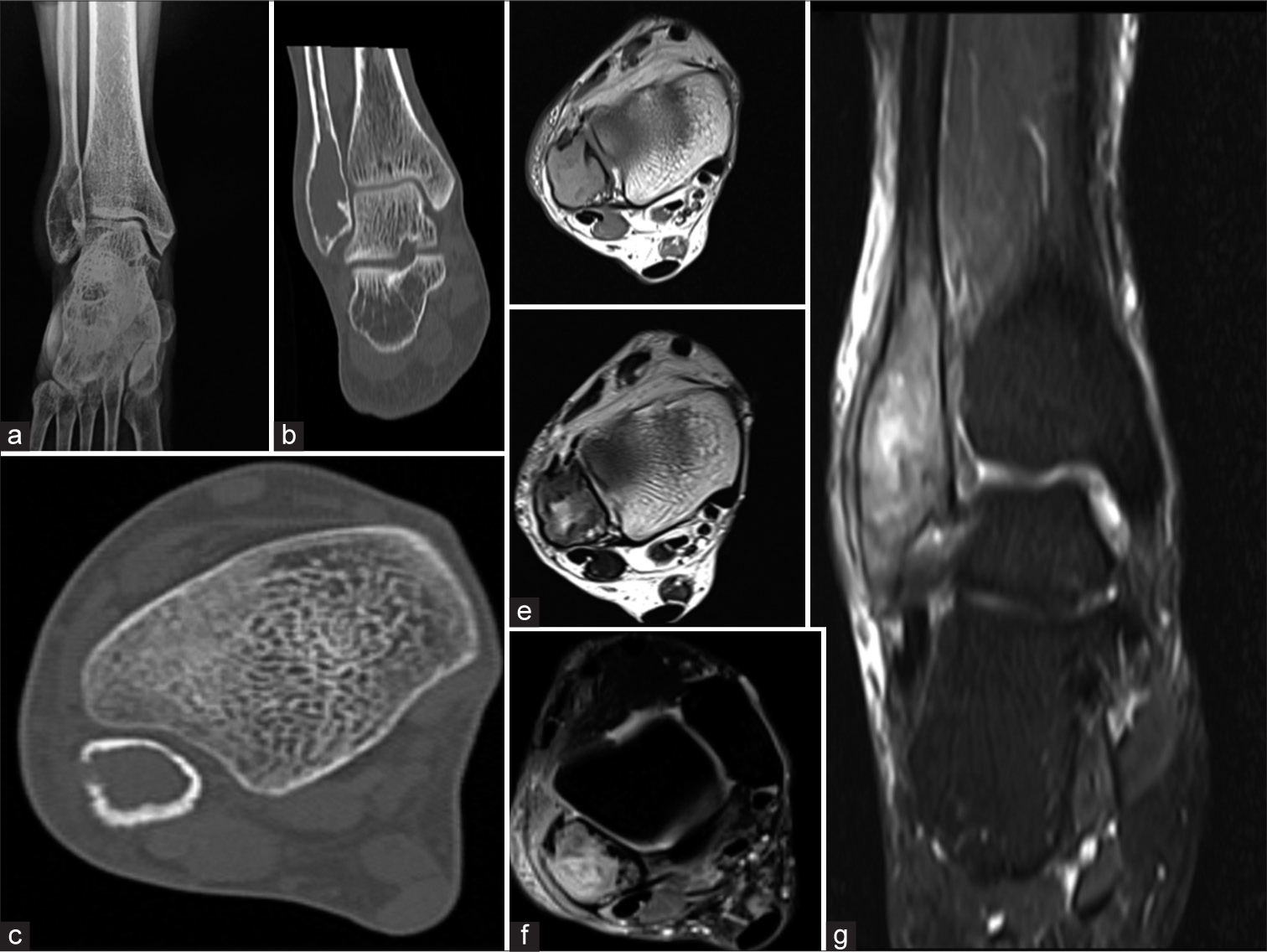 (a) Anterior-posterior radiograph, (b) Coronal computed tomography [CT] bone window, (c) Axial CT bone window. Lytic expansile lesion of the lateral malleolus with focal cortical break in the lateral aspect. No matrix calcification. No convincing periosteal reaction (d) Axial T1-weighted image, (e) Axial T2-weighted image, (f) Axial proton density fat-saturated sequence (PDFS), (g) Coronal short-tau inversion recovery [STIR]). The expansile solid lesion in the right distal fibula with some areas of focal cortical destruction extending upto the articular surface. The lesion displays an intermediate signal on T1/T2 and a hyperintense signal on STIR and PDFS. Edematous changes are seen in the perilesional soft tissues.