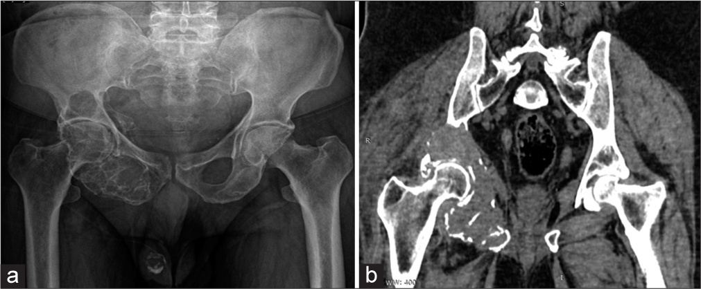 (a) Anterior-posterior radiograph of pelvis, (b) Coronal computed tomography (CT) image. A multiloculated lytic lesion with sharp non-sclerotic margin seen in the right pelvis involving the acetabulum and ischium. No calcification and periosteal reaction. Soft-tissue component with cortical breach better demonstrated on CT.