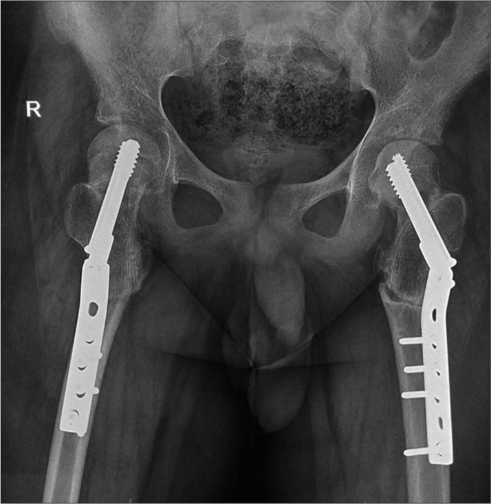 Radiograph of the pelvis with both hip joints. Post-operative status. Fixation screws in situ stabilizing both hip joints. Joint spaces and subjacent soft-tissue shadows appear normal.