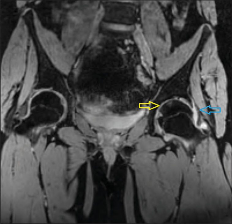 On the multiple echo recombined gradient echo coronal image, the yellow arrow shows mild thinning of articular cartilages over the left side femoral head and acetabulum, and the blue arrow shows mild synovial effusion involving the left hip joint.