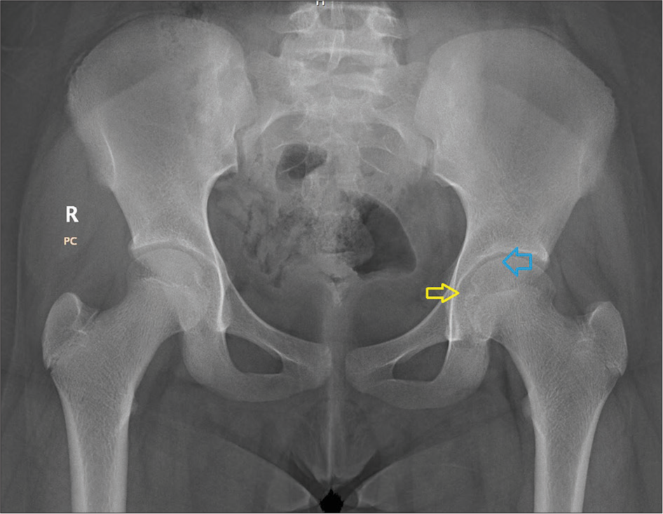 Three-month follow-up radiograph of pelvis with both hips. The blue arrow shows a normal smooth contour of the femoral epiphysis. The yellow arrow shows improved left hip joint space width. No obvious left pelvic tilt was noted.