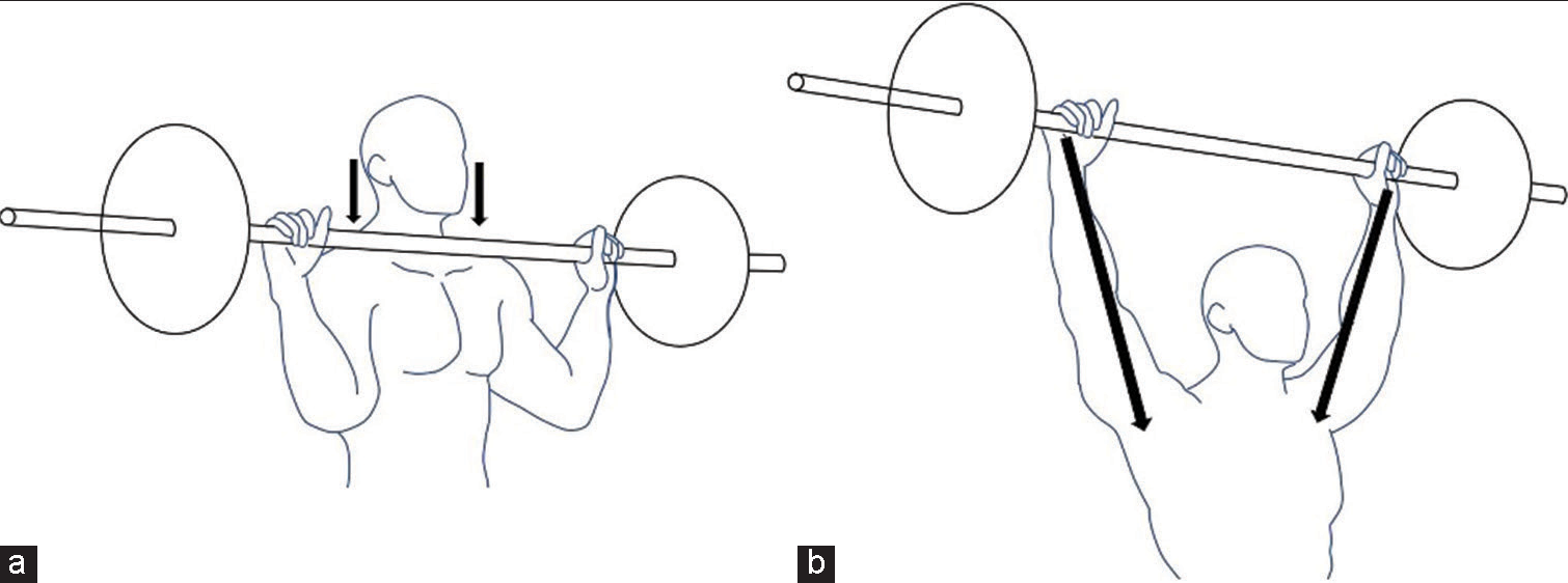 Diagrams showing (a) the resting phase of the clean and (b) the end of the jerk. After elevating the barbell in the clean phase, the weights rest on the lateral clavicles and acromioclavicular joints (ACJ). The force is transmitted vertically through the lateral clavicle and ACJ (black arrows), resulting in injuries to the clavicle and ACJ/capsule. At the end of the jerk phase, the weights are held at extension over the head. Injury to the deltoid, rotator cuff, glenohumeral ligaments, glenoid labrum, and glenohumeral joint capsule can be attributed to the forces transmitted (black arrows) along the line of the vector force.
