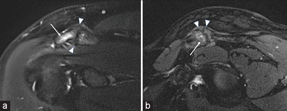 A 34-year-old male presenting with shoulder pain. T2-weighted fat-saturated (a) coronal and (b) sagittal magnetic resonance images demonstrating acromioclavicular joints sprain. Note bone marrow edema of the acromion (white arrows), thickening of the joint capsule-ligament complex (white arrowheads), and inhomogeneous intact capsule fibers.