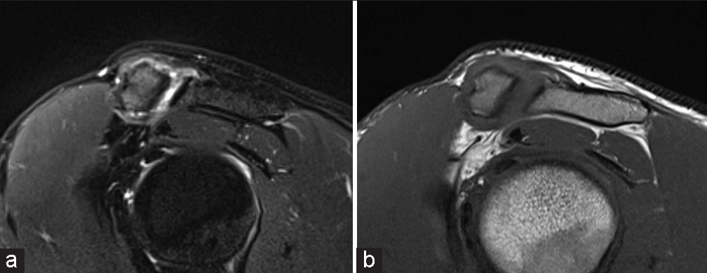 A 40-year-old male presenting with shoulder pain. (a) T2-weighted fat-saturated and (b) T1-weighted sagittal magnetic resonance images demonstrating acromioclavicular joints (ACJ) capsule rupture. The ACJ capsule-ligament complex is disrupted at the superior joint. A small joint effusion/hemarthrosis is also noted.