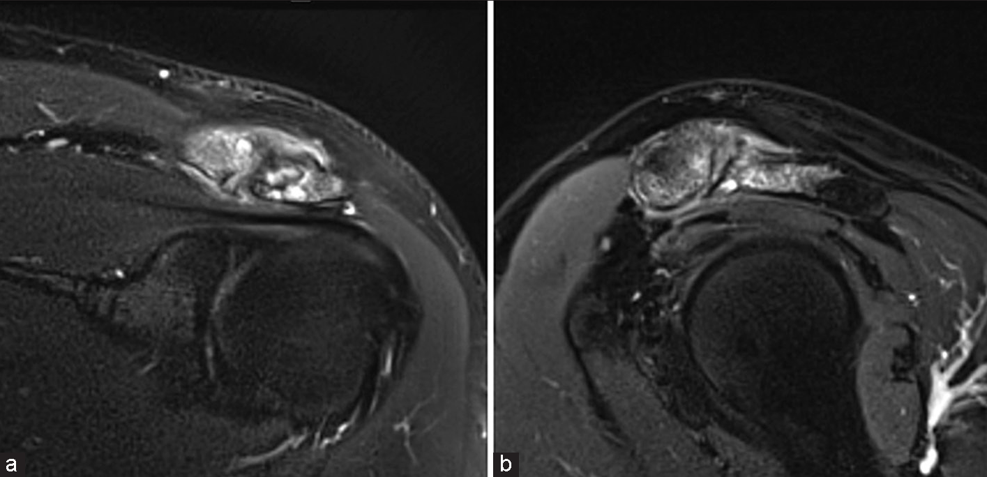 A 36-year-old male presenting with subacute shoulder pain. T2-weighted fat-saturated (a) coronal and (b) sagittal magnetic resonance images demonstrating post-traumatic acromioclavicular joints (ACJ) arthropathy. Note severe bone marrow edema of the lateral clavicle and acromion, subarticular cysts, and thickening of the ACJ capsule with surrounding soft-tissue edema.