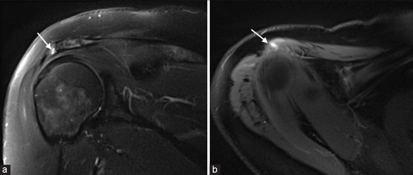 A 40-year-old female presenting with shoulder pain. T2-weighted fat-saturated (a) coronal and (b) axial magnetic resonance images demonstrating an intrasubstance tear of the acromial attachment of the deltoid tendon. Note linear high signal within the tendon attachment (white arrows).