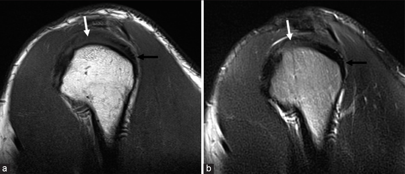 Magnetic resonance imaging patterns of shoulder injuries in strength ...