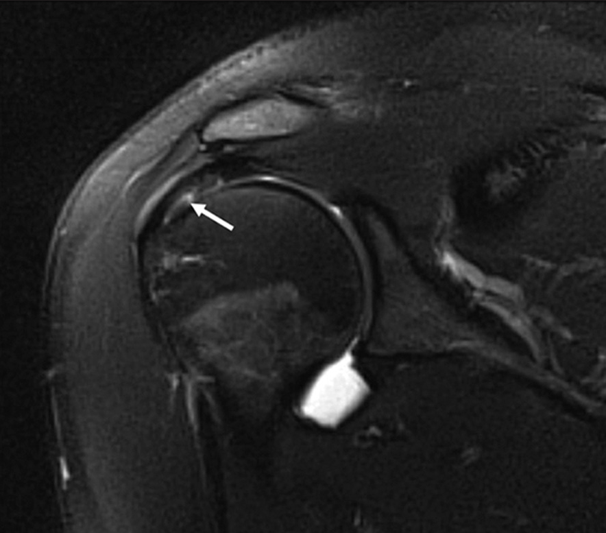 A 34-year-old female presenting with shoulder pain. T1-weighted fat-saturated coronal magnetic resonance arthrogram demonstrating a partial thickness articular surface tear of the supraspinatus tendon (white arrow).