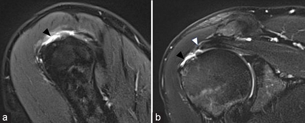 (a and b) A 44-year-old male presenting with shoulder pain. T2-weighted fat-saturated coronal magnetic resonance image demonstrating supraspinatus pseudo-impingement (black arrow head). There is hypertrophy of the supraspinatus muscle with increased muscle bulk and paucity of intramuscular fat. Similar changes are seen in the other periarticular muscles. There is overfilling of the subacromial space by the hypertrophied distal muscle belly and myotendon with resultant secondary indentation (white arrow head) of these structures by the overlying acromion and acromioclavicular joint, resulting in clinical features of impingement.