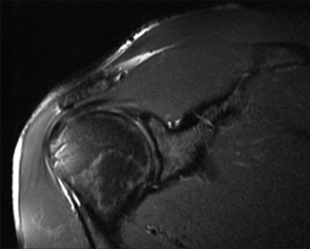 A 28-year-old male presenting with shoulder pain and decreased range of abduction. T2 weighted fat saturated coronal MR image demonstrating supraspinatus pseudo-impingement. There is hypertrophy of the supraspinatus muscle with increased muscle bulk and paucity of intramuscular fat. Similar changes are seen in the other periarticular muscles. There is overfilling of the subacromial space by the hypertrophied distal muscle belly and myotendon with resultant secondary indentation of these structures by the overlying acromion and AC joint, resulting in clinical features of impingement..