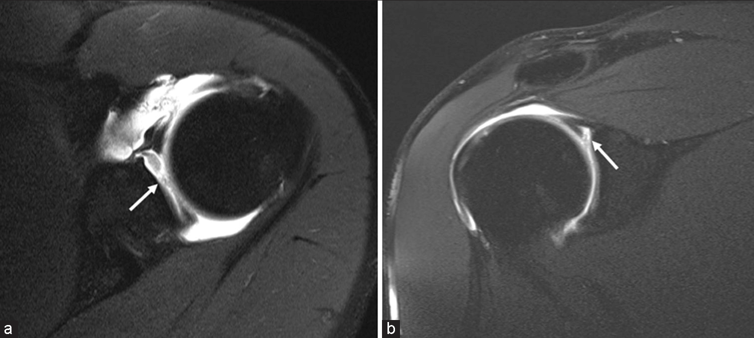 A 41-year-old male presenting with shoulder pain. T1-weighted fat-saturated (a) axial and (b) coronal magnetic resonance arthrogram images demonstrating a superior labral tear (SLAP Type 3) involving its anteroposterior extent (white arrows).