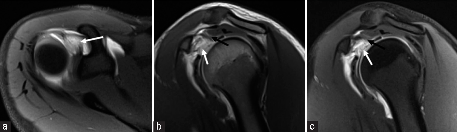A 19-year-old female presenting with shoulder pain following an injury during weightlifting training. T1-weighted fat-saturated (a) axial, (b) + (c) sagittal magnetic resonance arthrogram images demonstrating a full thickness tear of the superior glenohumeral ligament (SGHL) with discontinuity of the SGHL fibers (white arrows). The intact coracohumeral ligament is thickened and inhomogenous (black arrows). The SGHL and coracohumeral ligament together form the biceps pulley, which stabilizes the long head biceps tendon and glenohumeral joint.