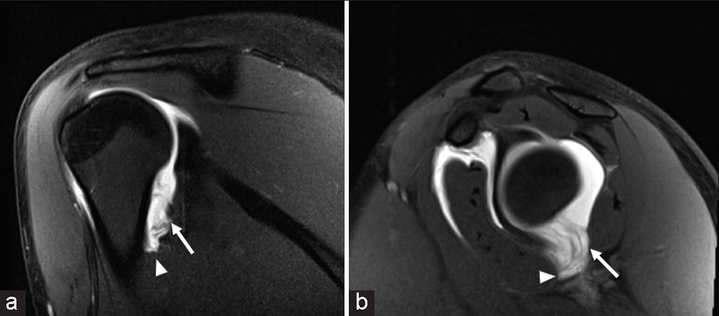 A 19-year-old female presenting with shoulder pain following an injury during weightlifting training. T1-weighted fat-saturated (a) coronal and (b) sagittal magnetic resonance arthrogram images demonstrating a complete rupture of the entire anteroposterior extent of the inferior glenohumeral ligament (IGHL)/ capsule complex from the humeral attachment. Note the disruption of the “U”-shaped IGHL/capsule complex fibers (white arrows) from the humeral attachment with the resultant extracapsular extension of intraarticular gadolinium contrast (white arrowheads), confirming the capsular injury.