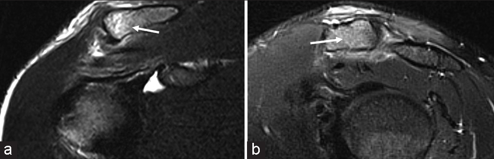 A 40-year-old male presenting with focal shoulder pain following an injury during strength training. T2-weighted fat-saturated (a) coronal and (b) sagittal magnetic resonance images demonstrating lateral clavicle marrow edema seen as T2 signal hyperintensity (white arrows). This is likely on the basis of trabecular stress injury from weightlifting mechanics. There is also a sprain of the adjacent inferior acromioclavicular joints capsule-ligament complex.