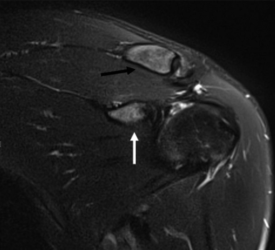 A 36-year-old male presenting with shoulder pain. T2-weighted fat-saturated coronal magnetic resonance image demonstrating a coracoid process stress reaction. There is bone marrow edema of the coracoid process (white arrow) and lateral clavicle marrow edema (black arrow).